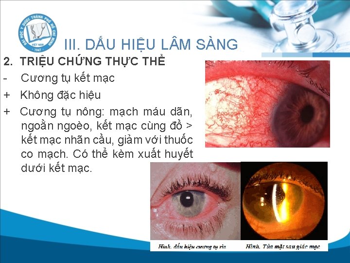 III. DẤU HIỆU L M SÀNG 2. + + TRIỆU CHỨNG THỰC THỂ Cương