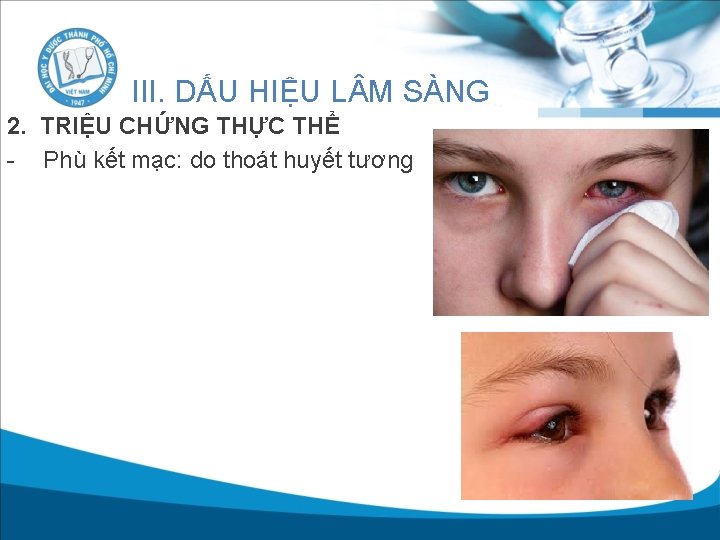 III. DẤU HIỆU L M SÀNG 2. TRIỆU CHỨNG THỰC THỂ - Phù kết