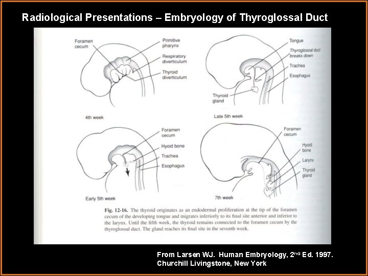 Radiological Presentations – Embryology of Thyroglossal Duct From Larsen WJ. Human Embryology, 2 nd