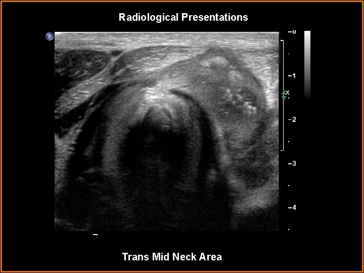 Radiological Presentations Trans Mid Neck Area 
