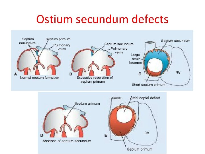 Ostium secundum defects 