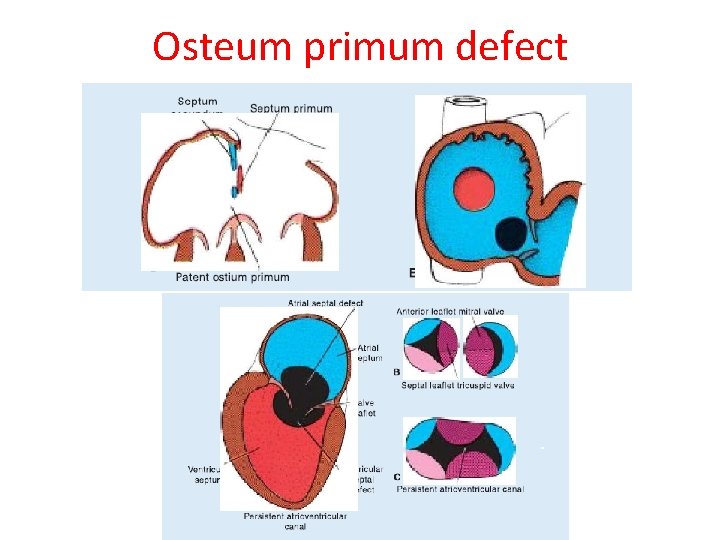 Osteum primum defect 