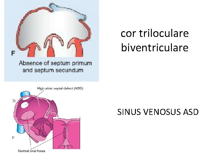 cor triloculare biventriculare SINUS VENOSUS ASD 