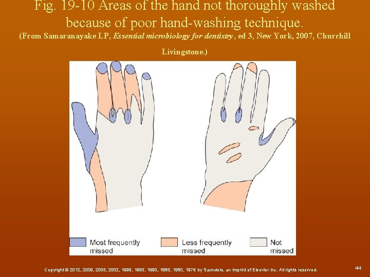 Fig. 19 -10 Areas of the hand not thoroughly washed because of poor hand-washing