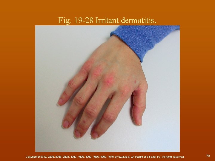 Fig. 19 -28 Irritant dermatitis. Copyright © 2012, 2009, 2005, 2002, 1999, 1995, 1990,