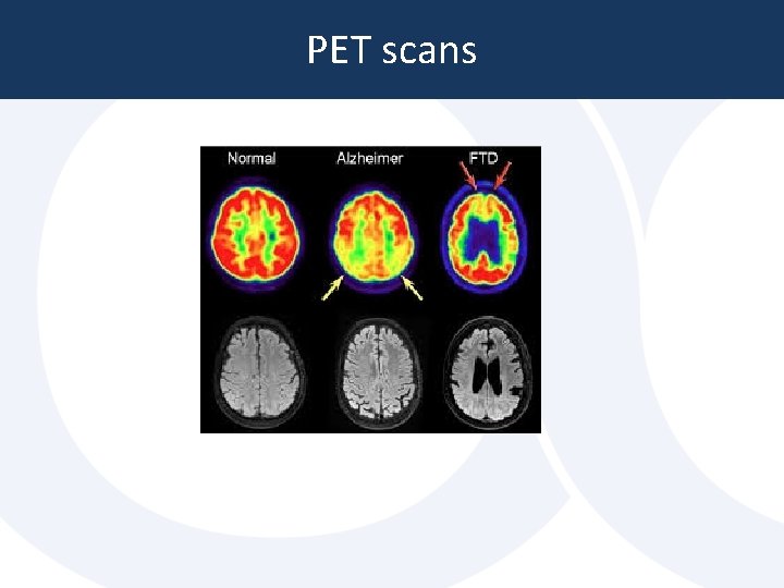 PET scans PET scans