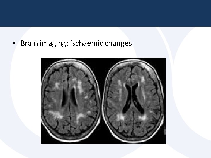 • Brain imaging: ischaemic changes • Brain imaging: ischaemic changes
