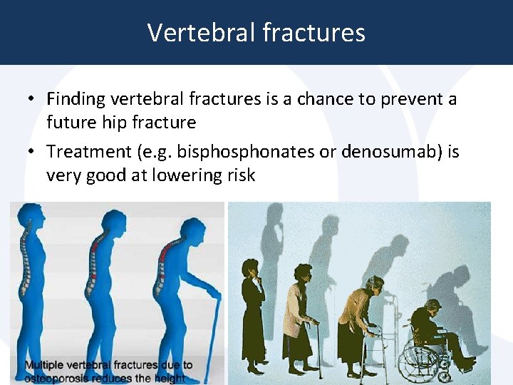 Vertebral fractures • Finding vertebral fractures is a chance to prevent a future hip Vertebral fractures • Finding vertebral fractures is a chance to prevent a future hip