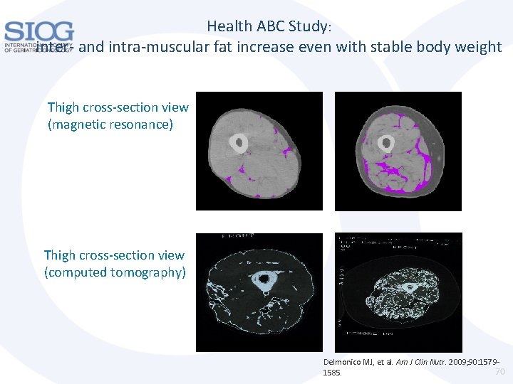 Health ABC Study: inter- and intra-muscular fat increase even with stable body weight Thigh Health ABC Study: inter- and intra-muscular fat increase even with stable body weight Thigh