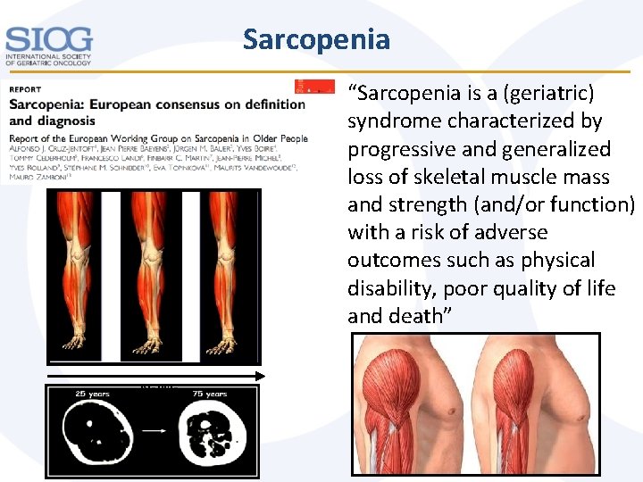 Sarcopenia “Sarcopenia is a (geriatric) syndrome characterized by progressive and generalized loss of skeletal Sarcopenia “Sarcopenia is a (geriatric) syndrome characterized by progressive and generalized loss of skeletal