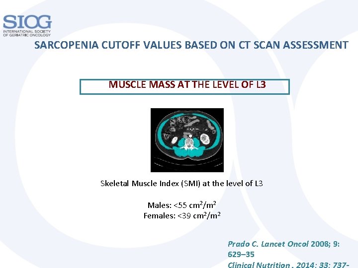 SARCOPENIA CUTOFF VALUES BASED ON CT SCAN ASSESSMENT MUSCLE MASS AT THE LEVEL OF SARCOPENIA CUTOFF VALUES BASED ON CT SCAN ASSESSMENT MUSCLE MASS AT THE LEVEL OF