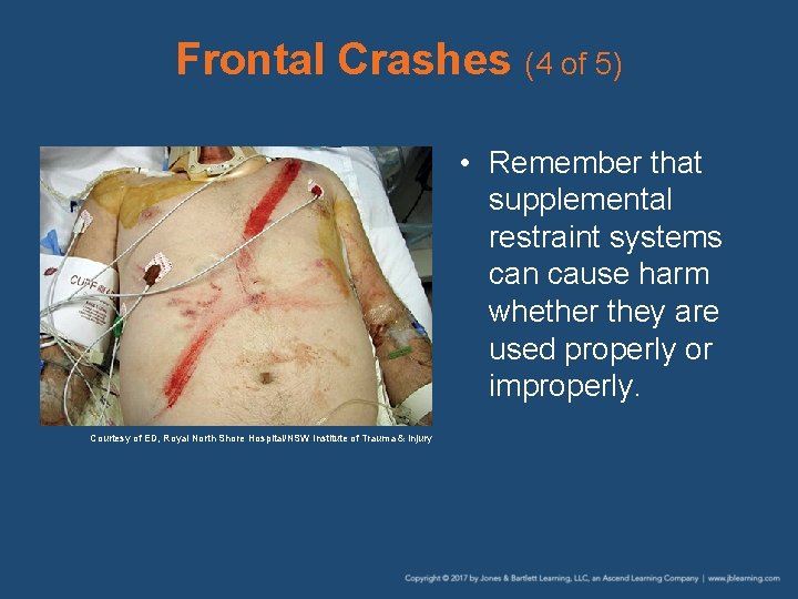 Frontal Crashes (4 of 5) • Remember that supplemental restraint systems can cause harm