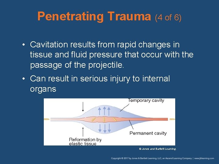 Penetrating Trauma (4 of 6) • Cavitation results from rapid changes in tissue and