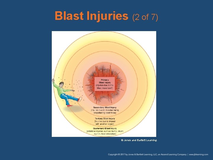 Blast Injuries (2 of 7) © Jones and Bartlett Learning. 