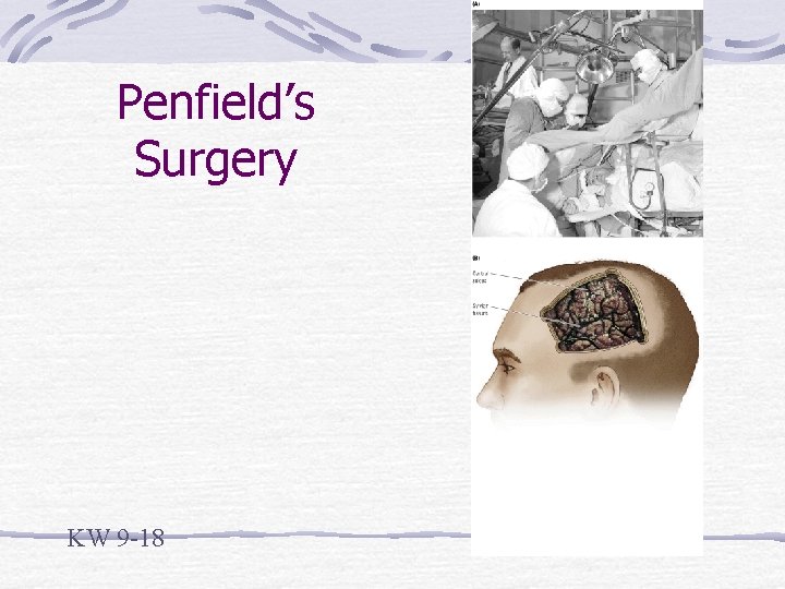 Penfield’s Surgery KW 9 -18 
