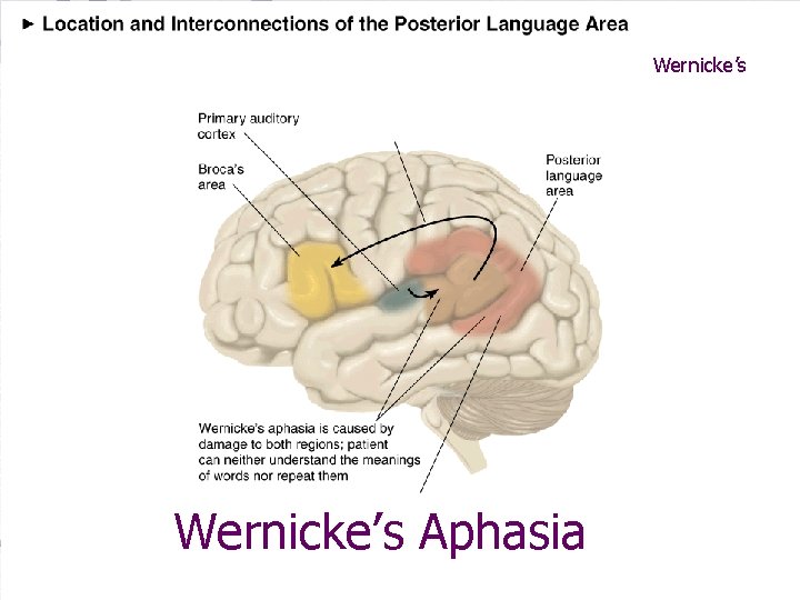 Wernicke’s Aphasia 