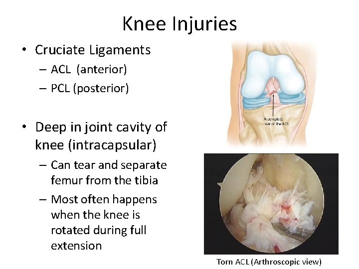 Knee Injuries • Cruciate Ligaments – ACL (anterior) – PCL (posterior) • Deep in