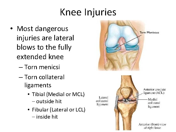 Knee Injuries • Most dangerous injuries are lateral blows to the fully extended knee