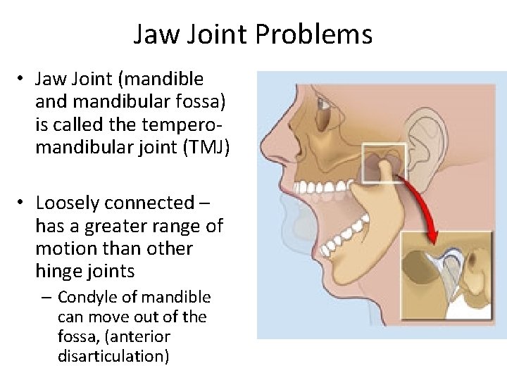 Jaw Joint Problems • Jaw Joint (mandible and mandibular fossa) is called the temperomandibular