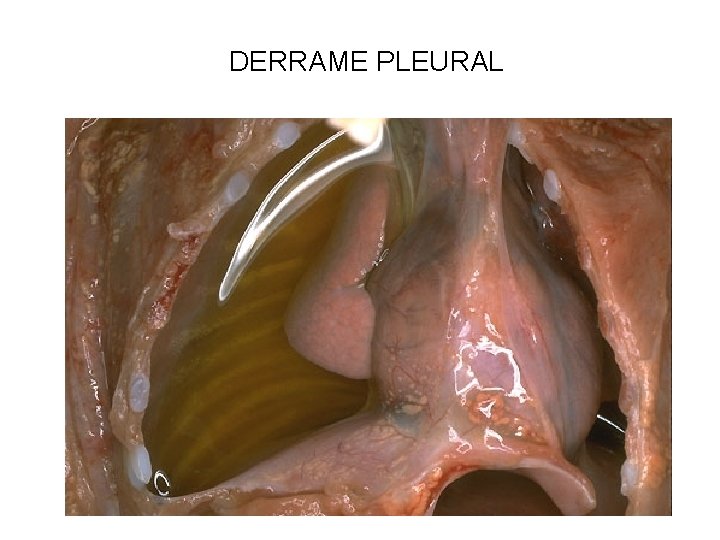 DERRAME PLEURAL 