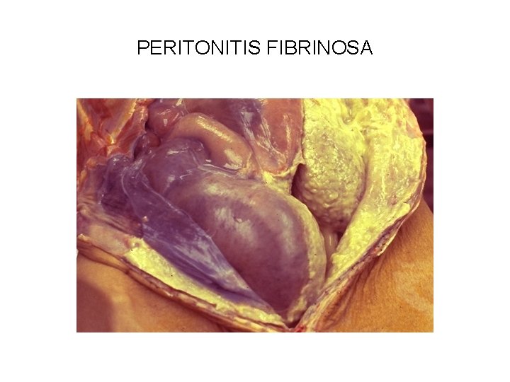 PERITONITIS FIBRINOSA 