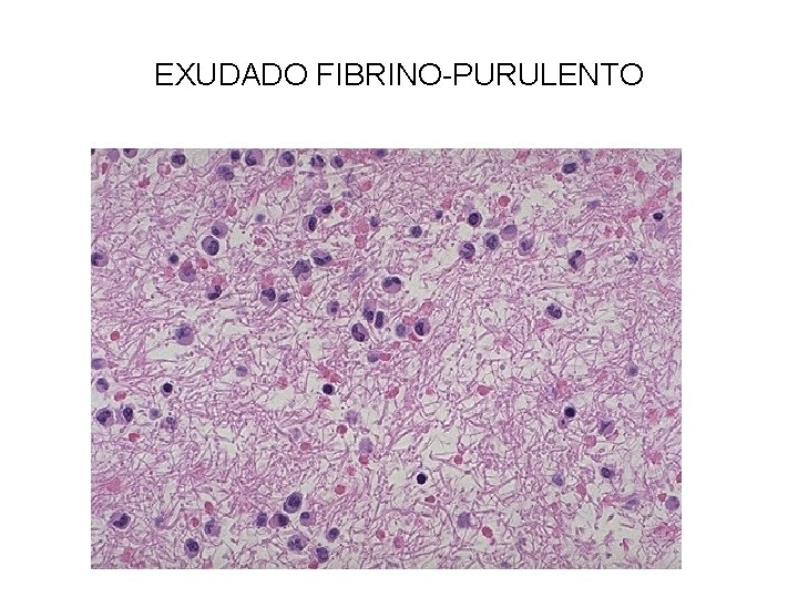 EXUDADO FIBRINO-PURULENTO 