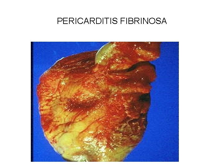 PERICARDITIS FIBRINOSA 
