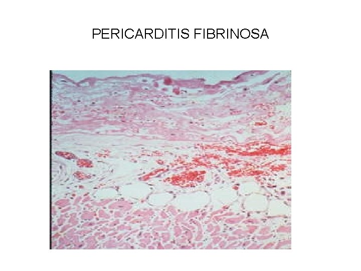 PERICARDITIS FIBRINOSA 