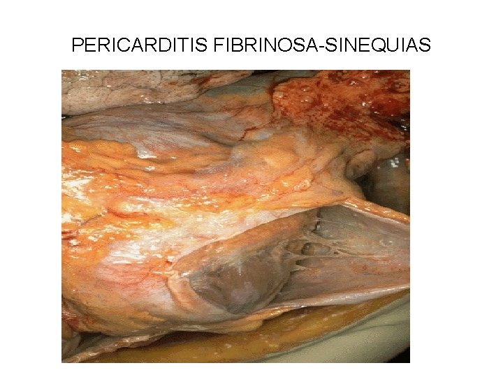 PERICARDITIS FIBRINOSA-SINEQUIAS 