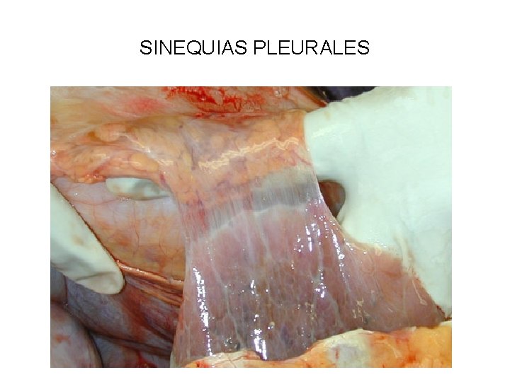 SINEQUIAS PLEURALES 