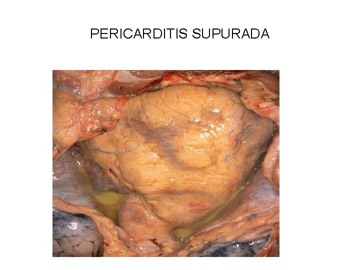 PERICARDITIS SUPURADA 