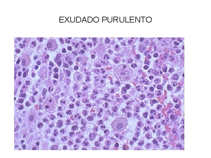 EXUDADO PURULENTO 