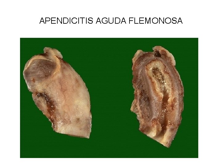 APENDICITIS AGUDA FLEMONOSA 