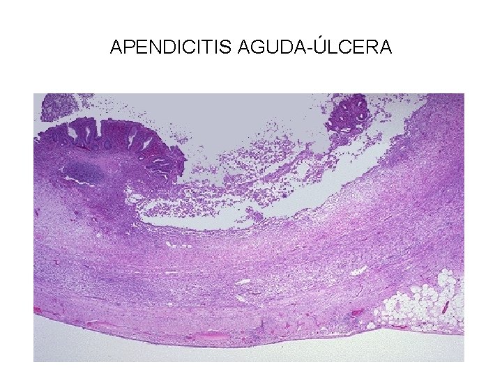 APENDICITIS AGUDA-ÚLCERA 