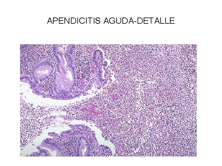 APENDICITIS AGUDA-DETALLE 