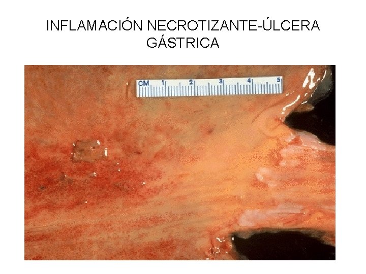 INFLAMACIÓN NECROTIZANTE-ÚLCERA GÁSTRICA 