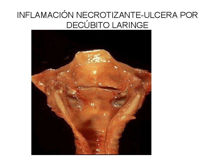 INFLAMACIÓN NECROTIZANTE-ULCERA POR DECÚBITO LARINGE 