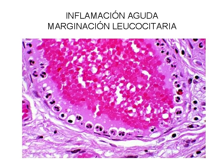 INFLAMACIÓN AGUDA MARGINACIÓN LEUCOCITARIA 