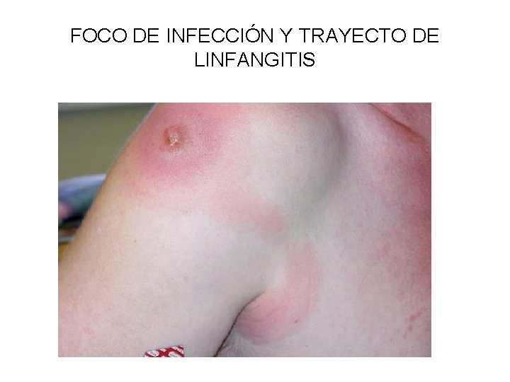 FOCO DE INFECCIÓN Y TRAYECTO DE LINFANGITIS 