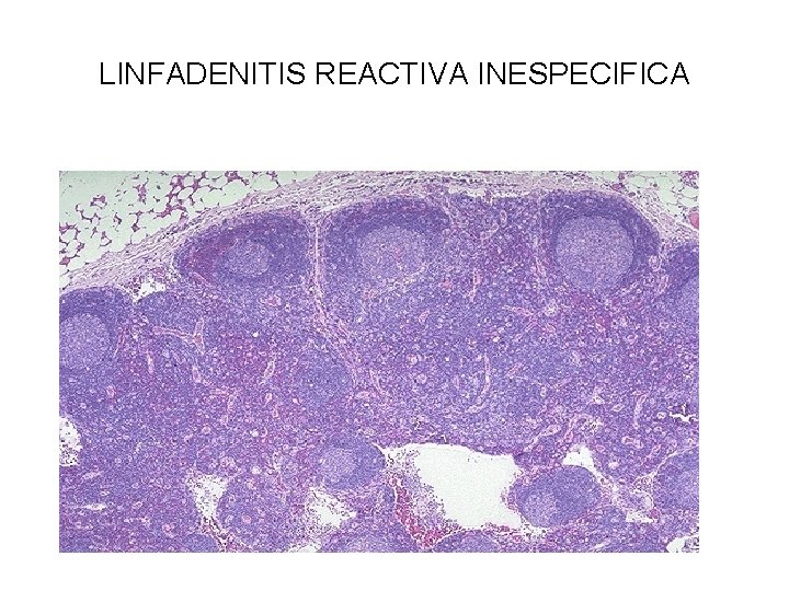 LINFADENITIS REACTIVA INESPECIFICA 