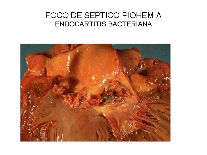 FOCO DE SEPTICO-PIOHEMIA ENDOCARTITIS BACTERIANA 