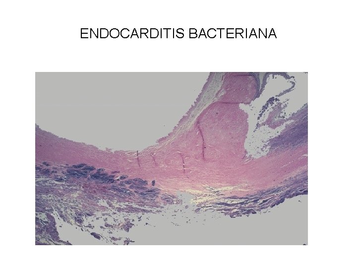 ENDOCARDITIS BACTERIANA 