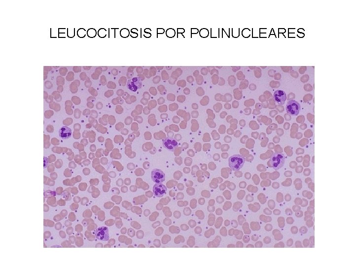 LEUCOCITOSIS POR POLINUCLEARES 