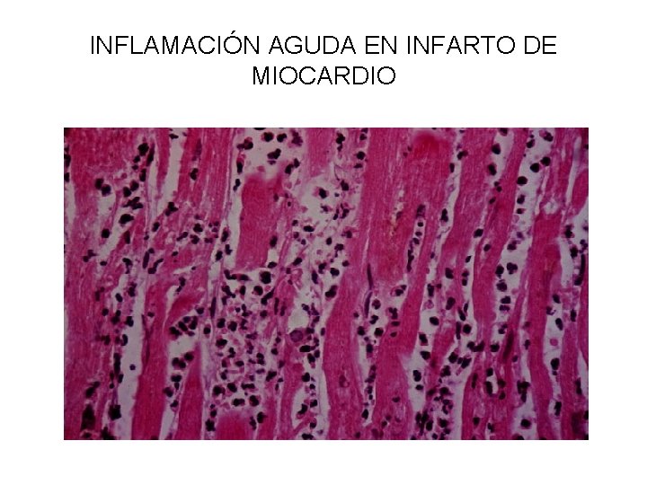 INFLAMACIÓN AGUDA EN INFARTO DE MIOCARDIO 
