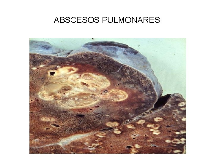 ABSCESOS PULMONARES 
