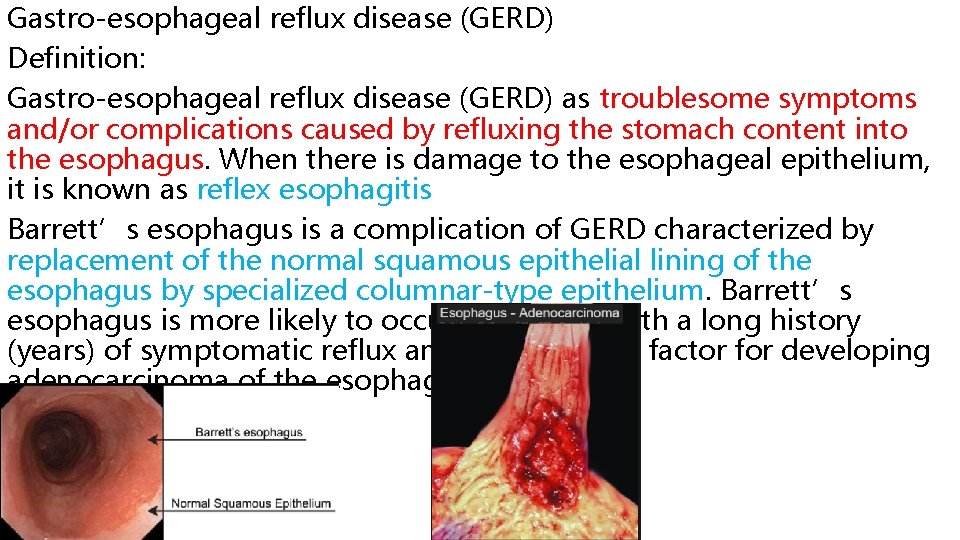 Gastro-esophageal reflux disease (GERD) Definition: Gastro-esophageal reflux disease (GERD) as troublesome symptoms and/or complications