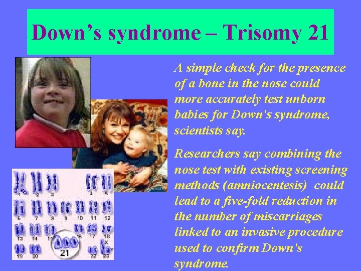 Down’s syndrome – Trisomy 21 A simple check for the presence of a bone