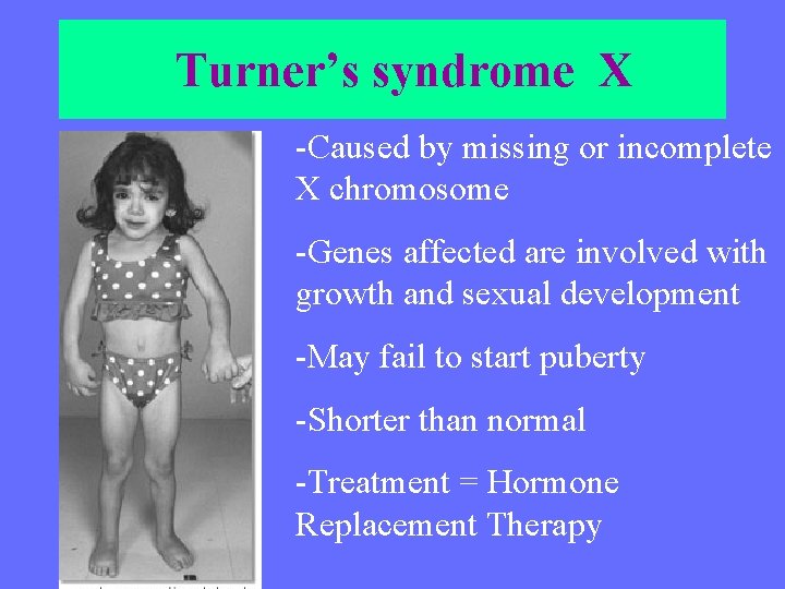  Turner’s syndrome X -Caused by missing or incomplete X chromosome -Genes affected are