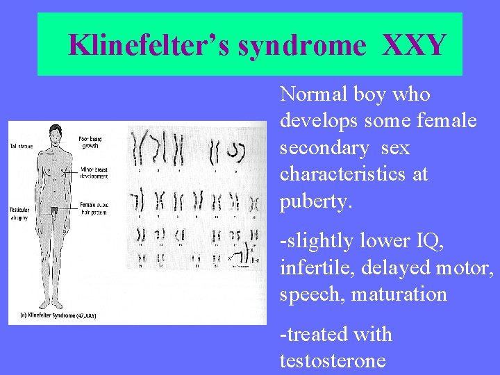  Klinefelter’s syndrome XXY Normal boy who develops some female secondary sex characteristics at