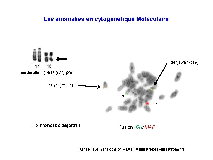 Les anomalies en cytogénétique Moléculaire der(16)t(14; 16) translocation t(14; 16)(q 32; q 23) der(14)t(14;